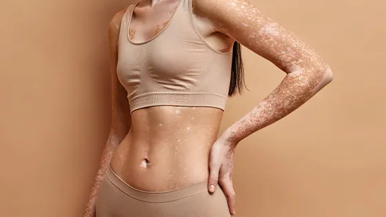 Redução de Cicatrizes e Estrias