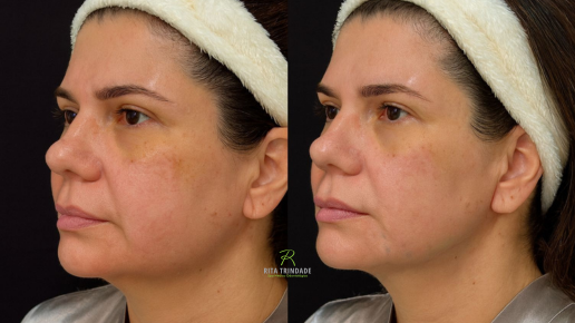 Lifting Natural, Colágeno Ativado